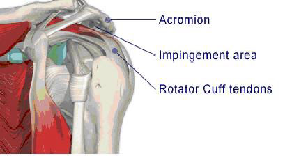 shoulder impingement